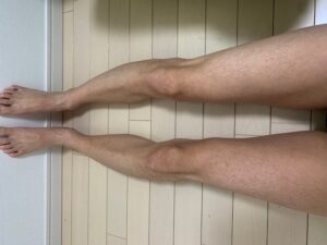 2回目の足脱毛から２カ月経過：足全体の画像