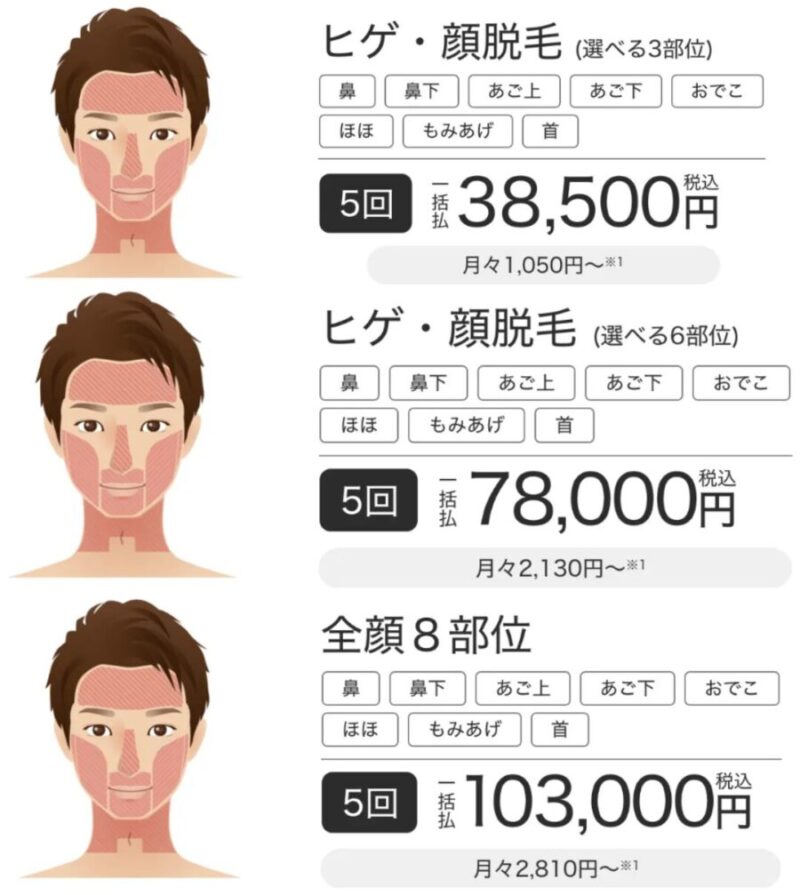 メンズエミナル：ヒゲ脱毛の施術部位