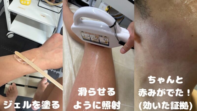 セルフ脱毛の施術手順・風景