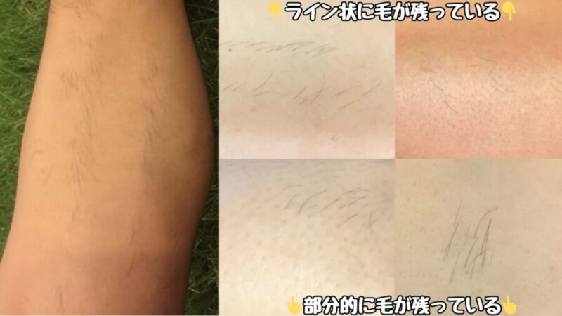 脱毛の照射漏れ
