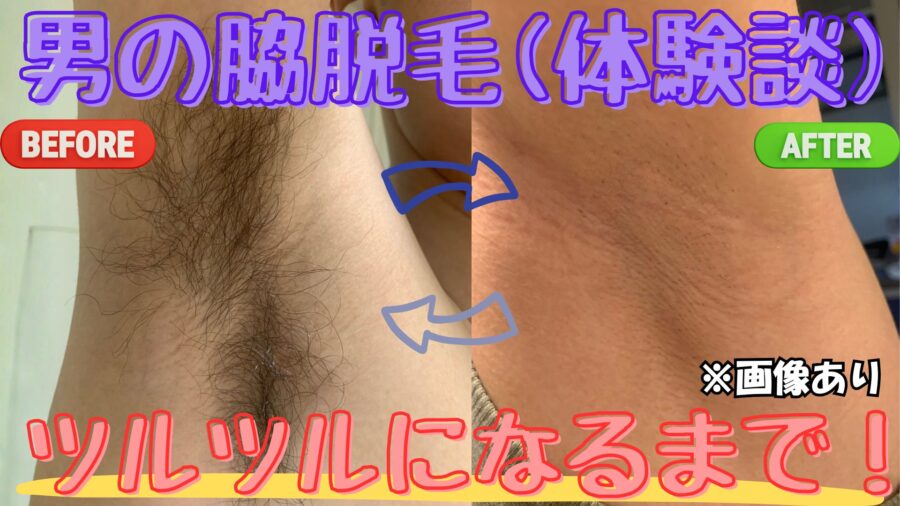 脇脱毛で男の濃い脇毛がツルツルになるまでの体験談