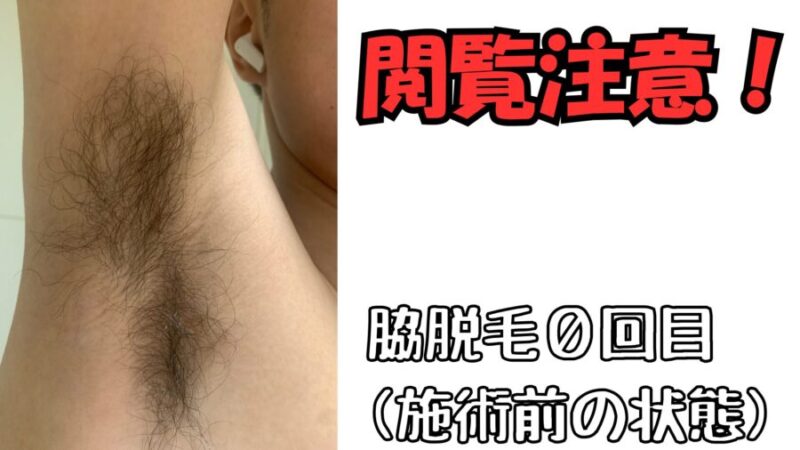 脇脱毛の施術前のボーボーの状態
