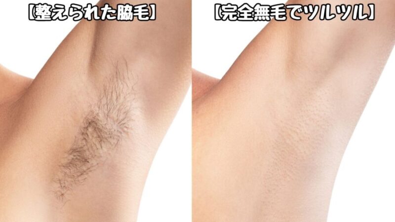 整えられた男の脇毛とツルツルの脇を比較