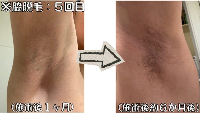 脇脱毛:5回目