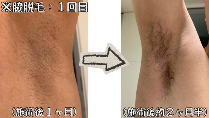 脇脱毛:1回目