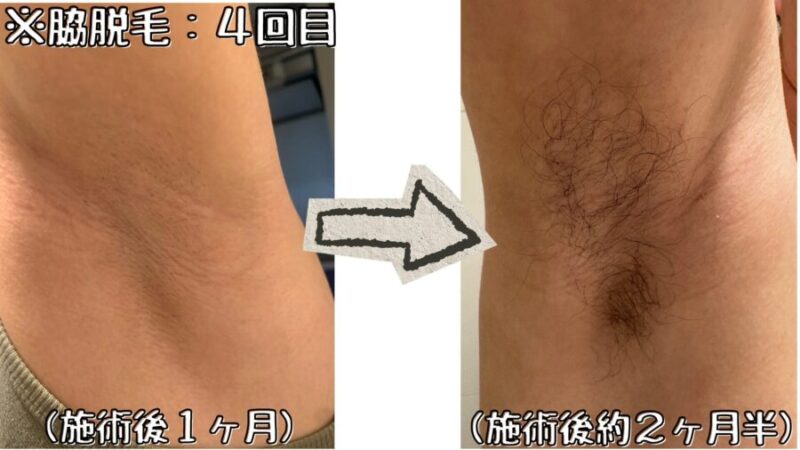 脇脱毛:4回目