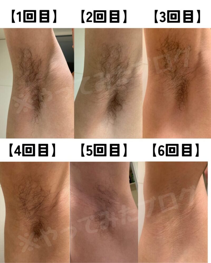 脇脱毛:1回目~6回目までの脱毛効果