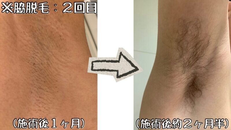 脇脱毛:2回目