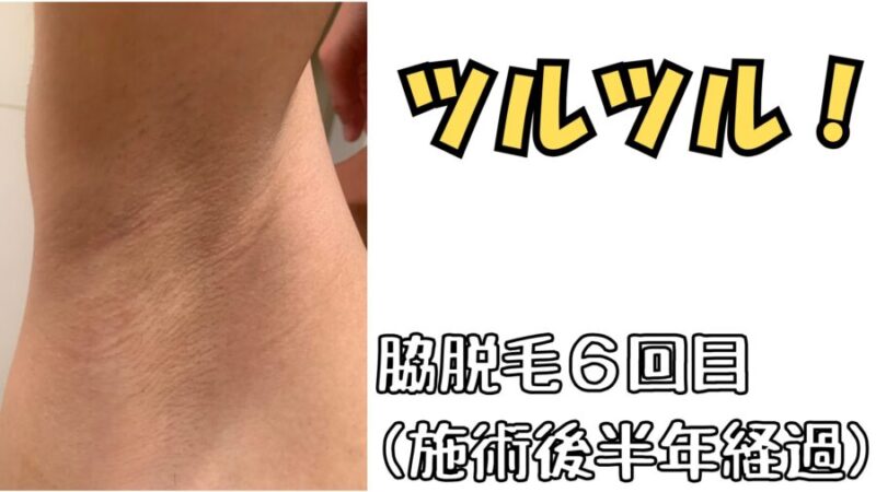 脇脱毛:6回目