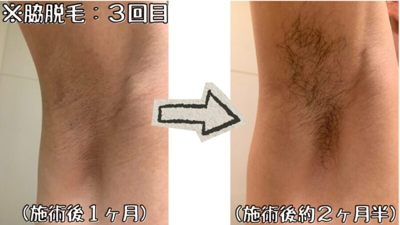 脇脱毛:3回目