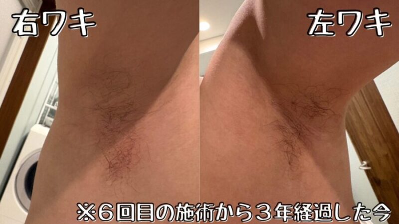 脇脱毛:6回目の施術後3年経過した現在の様子